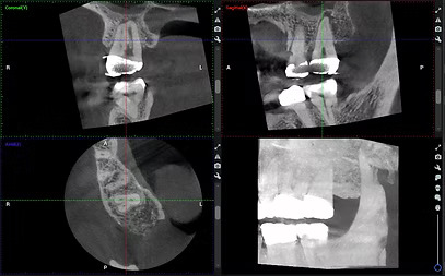 CBCT